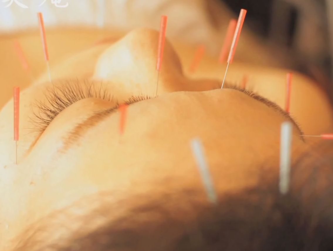 美容鍼